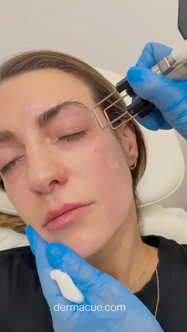 ✨ LÁSER CO2: RENOVACIÓN PROFUNDA DE LA PIEL ✨

El Láser CO2 es uno de los tratamientos más avanzados en dermatología para mejorar la calidad de la piel de forma eficaz y segura. Actúa estimulando la regeneración cutánea y la producción de colágeno, logrando una piel más uniforme, luminosa y saludable.

Está indicado para tratar:
• Cicatrices (acné, quirúrgicas)
• Manchas y daño solar
• Textura irregular y poros dilatados
• Líneas finas y signos de envejecimiento

En DERMACUE, este tratamiento se realiza siempre tras una valoración médica personalizada y bajo la supervisión de Médicos Dermatólogos, garantizando seguridad, precisión y resultados reales.

🔹 Porque tu piel es un órgano, confíala solo a especialistas.
DERMACUE — Dermatología Médica, Ética y Estética
#DERMACUE #DermatologíaMédica #DermatologíaEstética #Dermatólogos #CuidadoDeLaPiel SaludDeLaPiel SkincareDermatológico SerumRenovador PielRenovada RegeneraciónCutánea CalidadDeLaPiel RutinaNocturna SkincareAvanzado CuidadoDeInvierno PielEnInvierno RegálatePielSana NavidadConCiencia BeautyConCiencia SkincareConCiencia Dermocosmética CienciaYPiel FormuladoPorDermatólogos